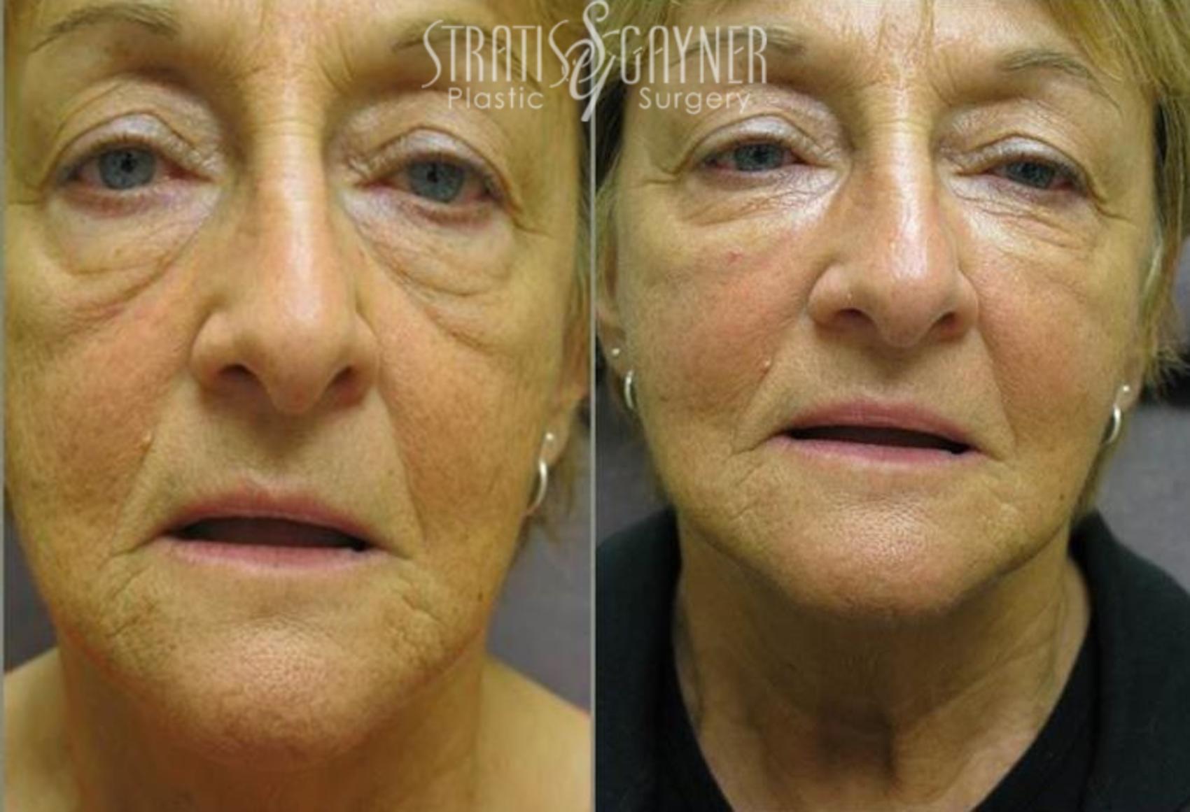 Before & After Dermal Fillers Case 185 View #1 View in Harrisburg, PA