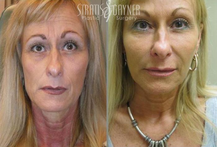 Before & After Dermal Fillers Case 186 View #1 View in Harrisburg, PA