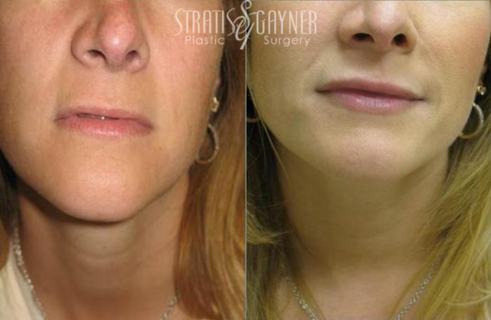 Before & After Dermal Fillers Case 187 View #1 View in Harrisburg, PA