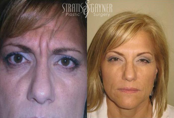 Before & After Dermal Fillers Case 188 View #1 View in Harrisburg, PA