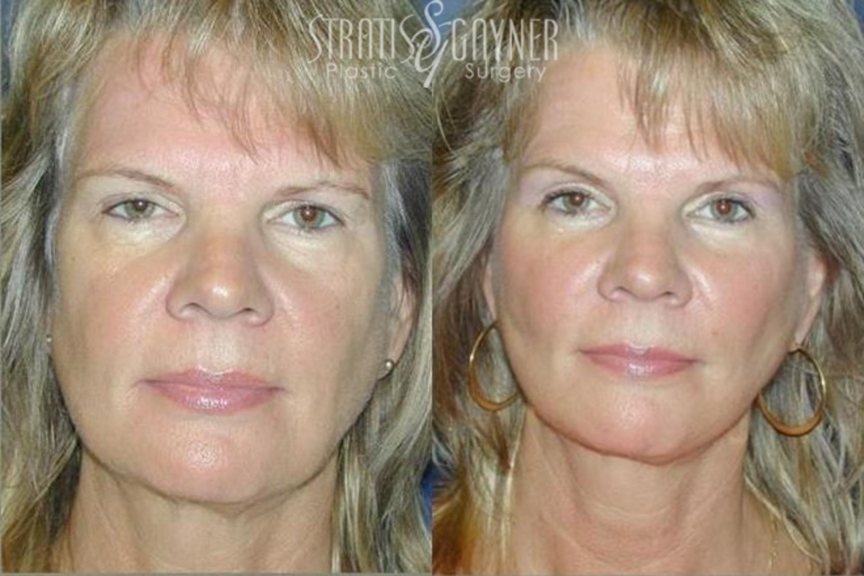 Before & After Dermal Fillers Case 189 View #1 View in Harrisburg, PA