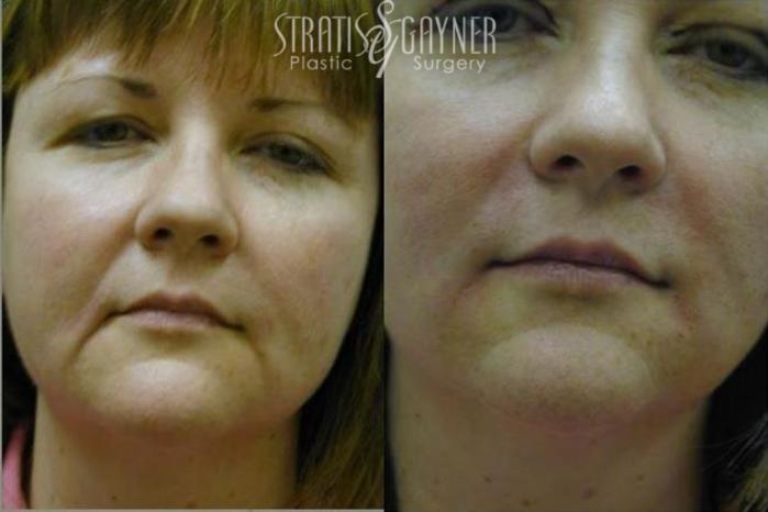 Before & After Dermal Fillers Case 190 View #1 View in Harrisburg, PA