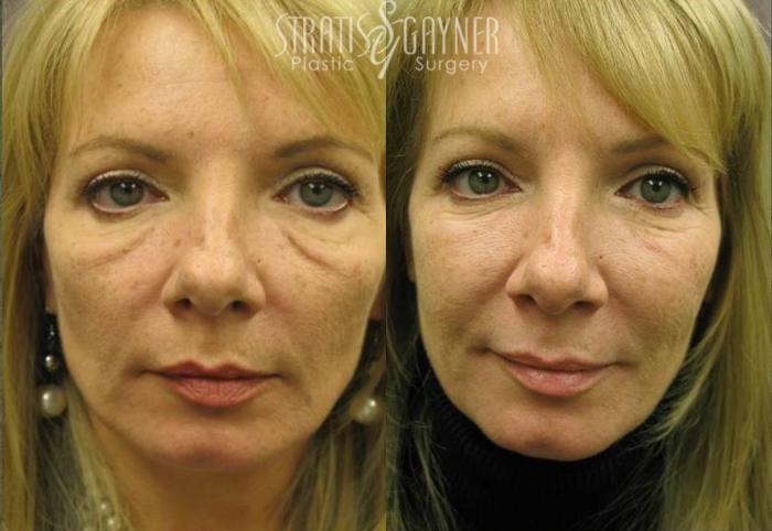 Before & After Dermal Fillers Case 191 View #1 View in Harrisburg, PA