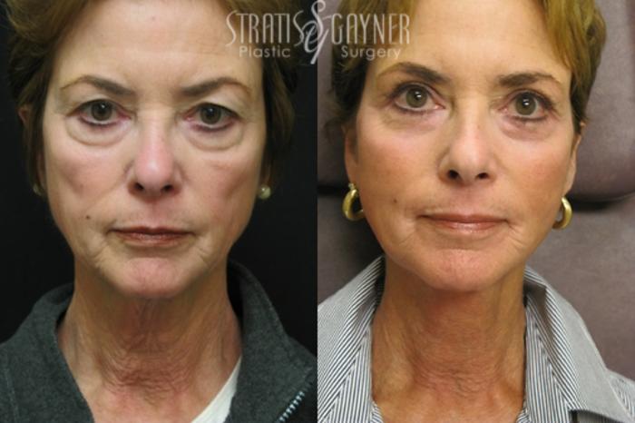 Before & After Eyelid Surgery Case 209 Front View in Harrisburg, PA