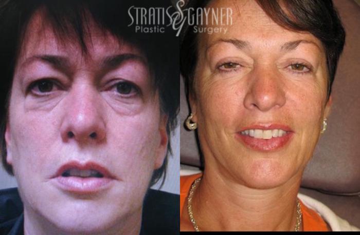 Before & After Eyelid Surgery Case 211 Front View in Harrisburg, PA