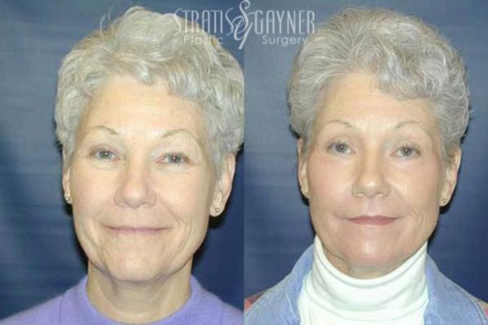 Before & After Eyelid Surgery Case 212 Front View in Harrisburg, PA