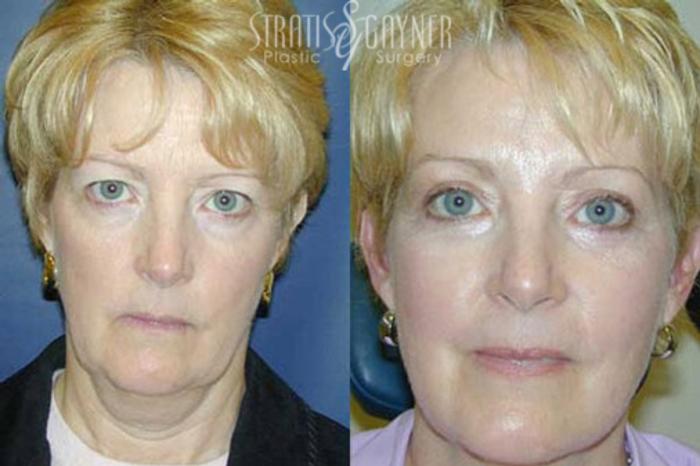 Before & After Eyelid Surgery Case 213 Front View in Harrisburg, PA