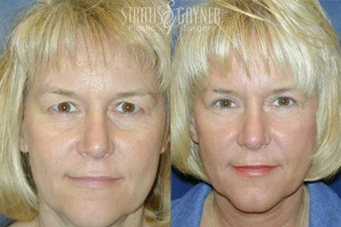 Before & After Eyelid Surgery Case 215 Front View in Harrisburg, PA