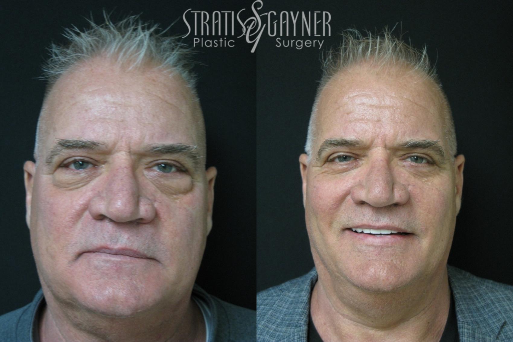 Before & After Eyelid Surgery Case 223 Front View in Harrisburg, PA