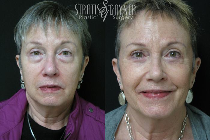 Before & After Eyelid Surgery Case 224 Front View in Harrisburg, PA