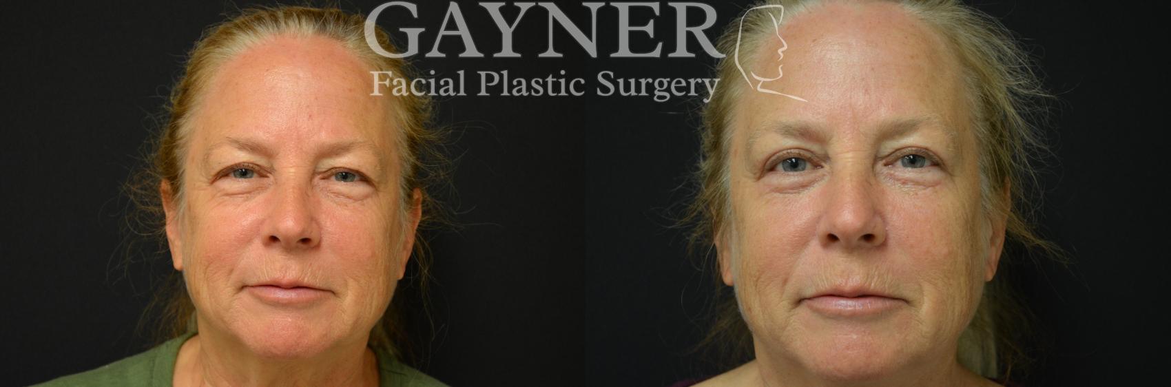 Before & After Eyelid Surgery Case 228 Front View in Harrisburg, PA