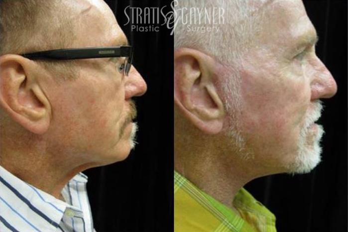 Before & After Facelift for Men Case 205 View #1 View in Harrisburg, PA