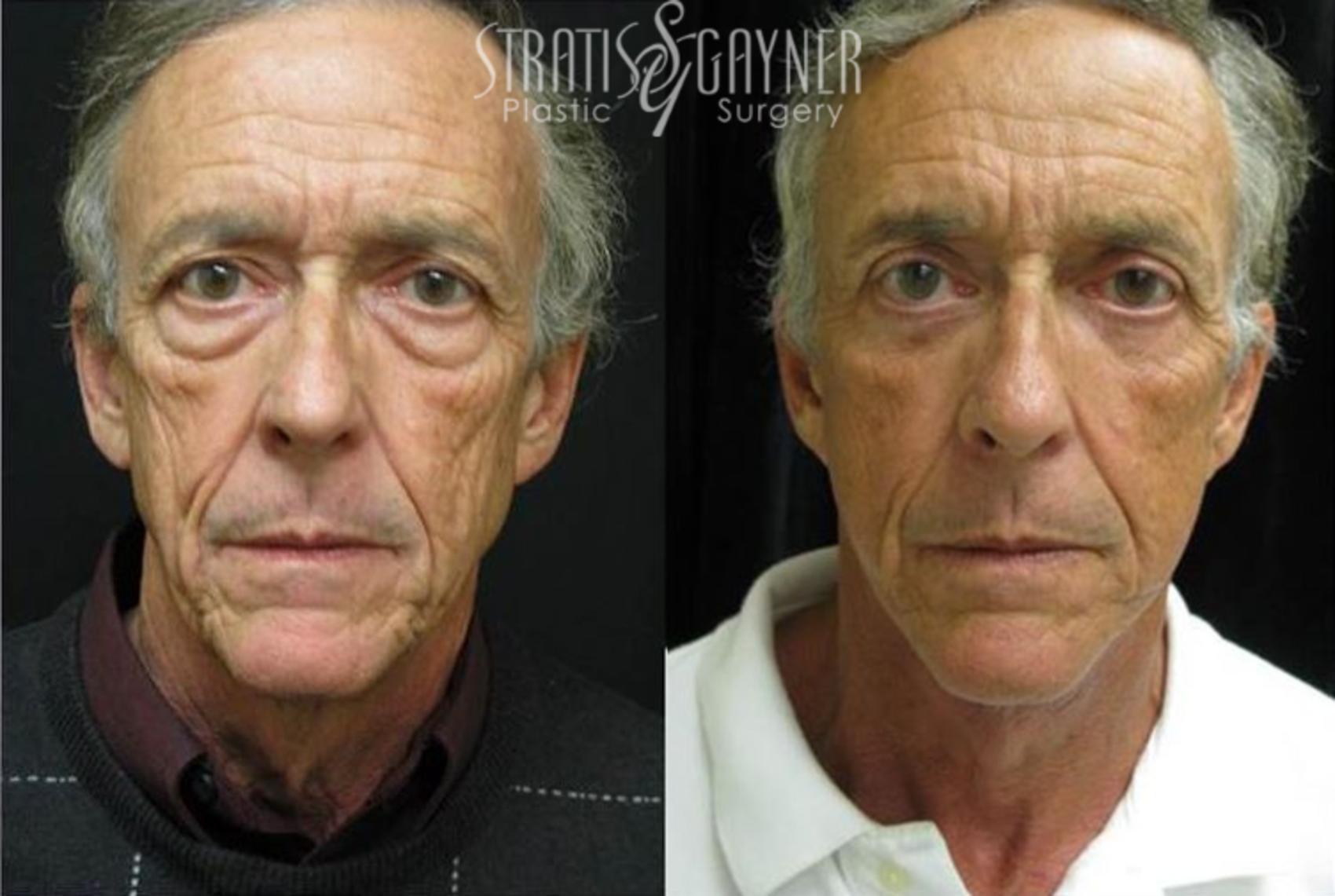 Before & After Facelift for Men Case 206 View #1 View in Harrisburg, PA