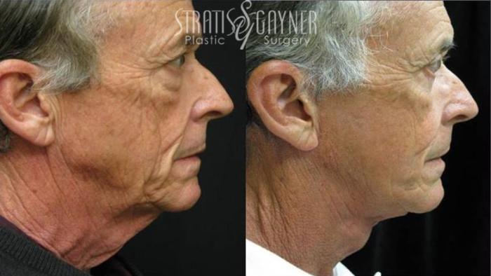 Before & After Facelift for Men Case 206 View #2 View in Harrisburg, PA