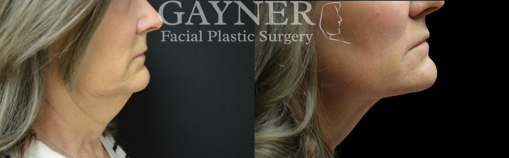 Before & After Facial Liposuction Case 229 Right Side View in Harrisburg, PA