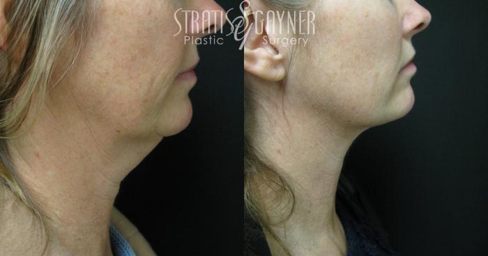 Before & After Facial Liposuction Case 34 View #1 View in Harrisburg, PA