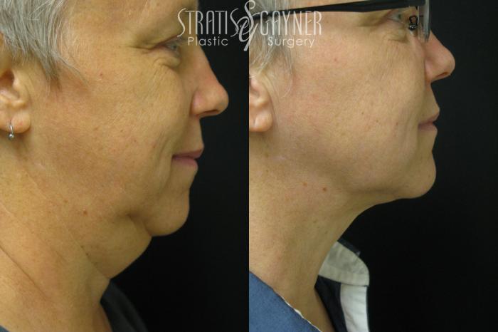 Before & After Facial Liposuction Case 35 View #1 View in Harrisburg, PA