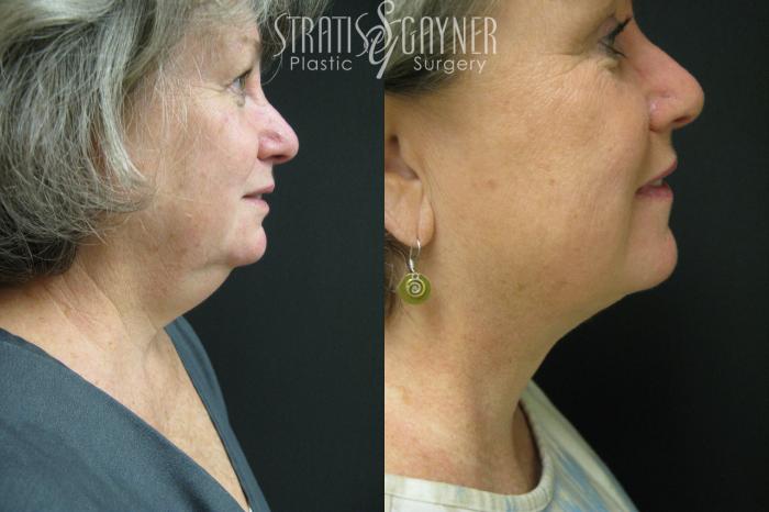 Before & After Facial Liposuction Case 36 View #1 View in Harrisburg, PA