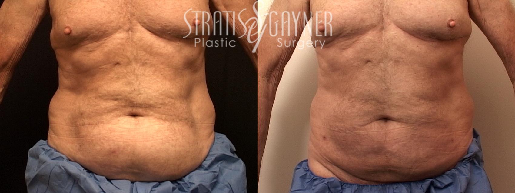 Before & After Liposuction Case 127 View #1 View in Harrisburg, PA