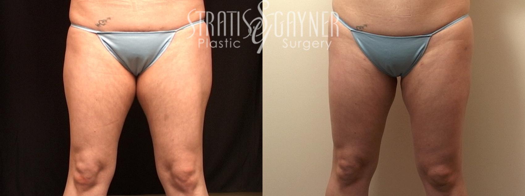 Before & After Liposuction Case 47 View #1 View in Harrisburg, PA