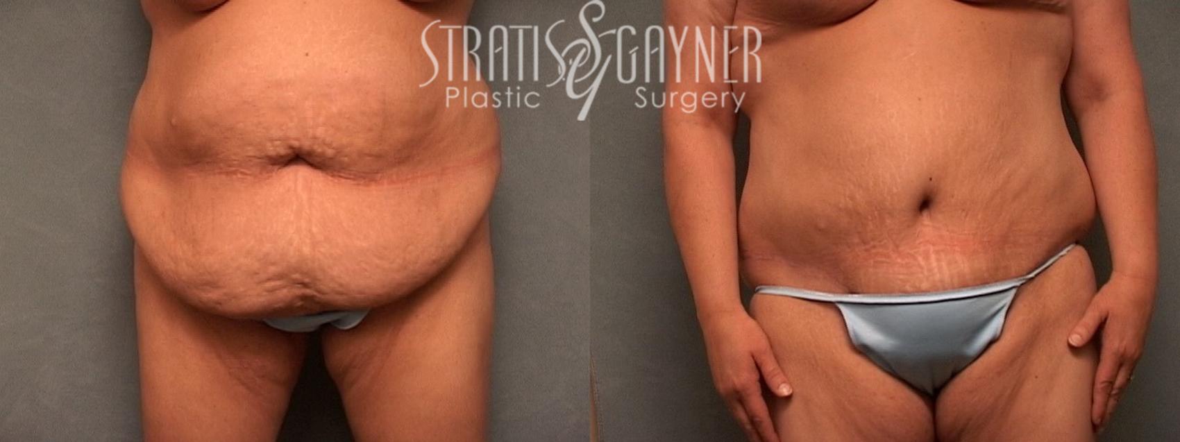 Before & After Plastic Surgery After Weight Loss Case 26 View #1 View in Harrisburg, PA