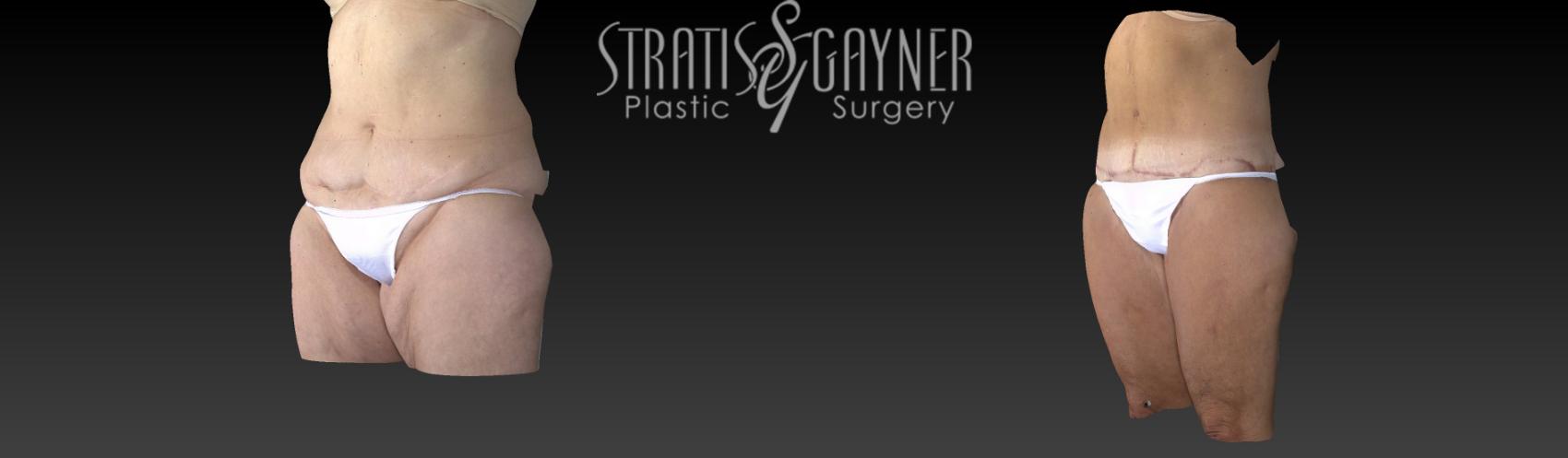 Before & After Plastic Surgery After Weight Loss Case 58 View #3 View in Harrisburg, PA