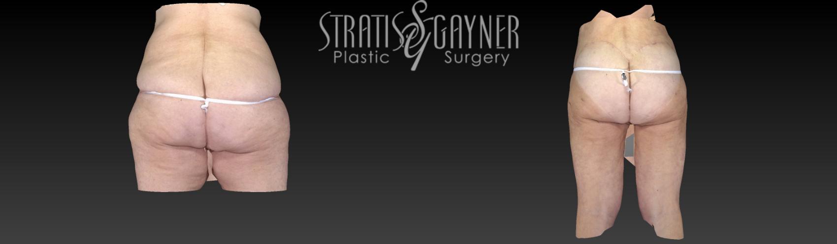 Before & After Plastic Surgery After Weight Loss Case 58 View #5 View in Harrisburg, PA