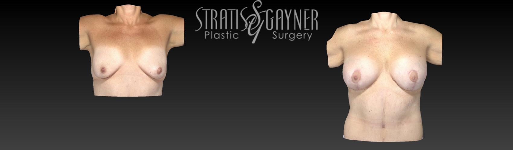 Before & After Plastic Surgery After Weight Loss Case 58 View #6 View in Harrisburg, PA