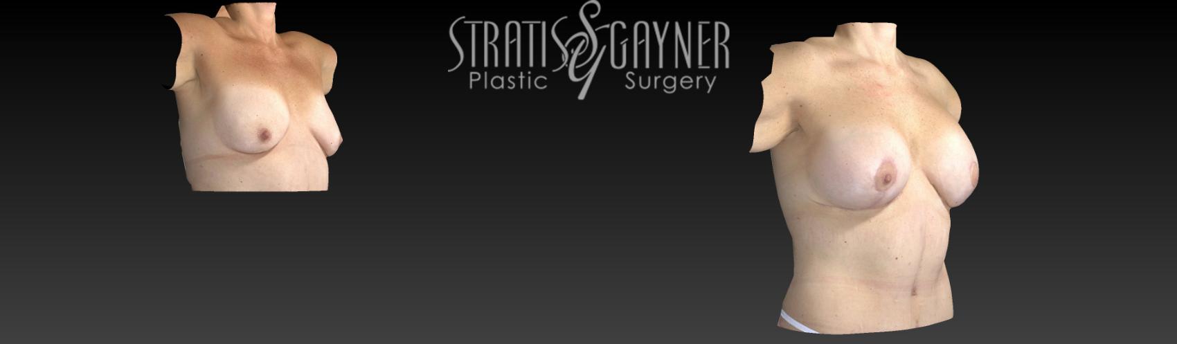 Before & After Plastic Surgery After Weight Loss Case 58 View #7 View in Harrisburg, PA
