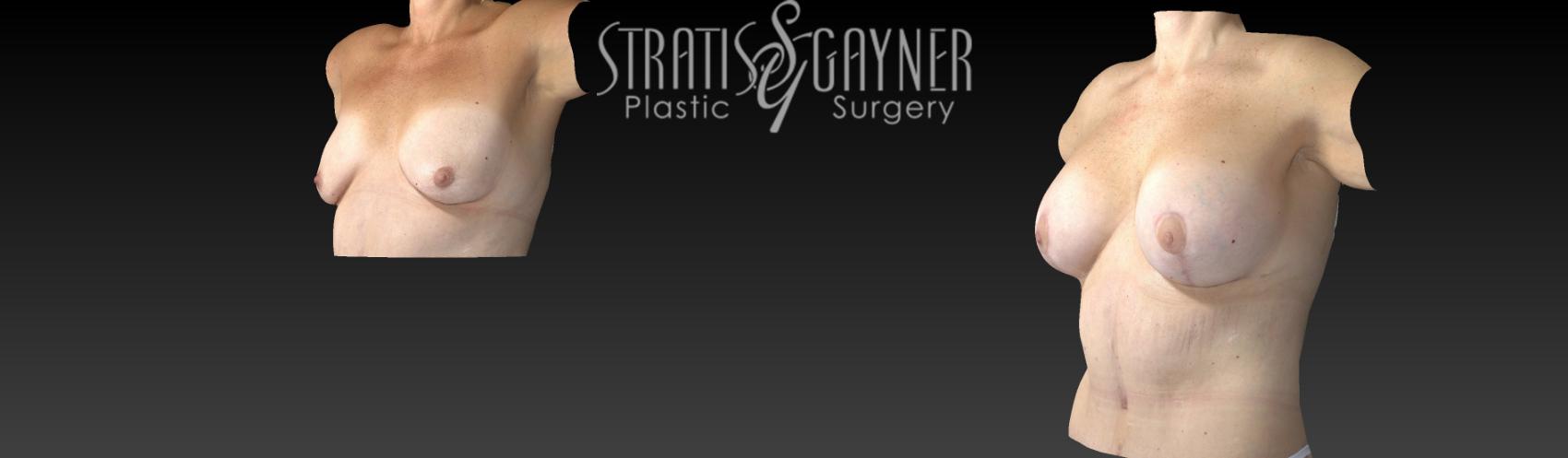 Before & After Plastic Surgery After Weight Loss Case 58 View #8 View in Harrisburg, PA