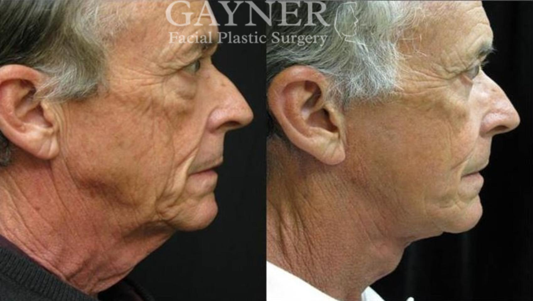 Procedures for Men Before and After Pictures Case 206 Harrisburg, PA