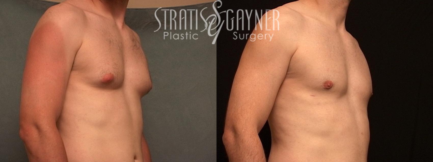 Before & After Male Breast Reduction Case 219 Left Oblique View in Harrisburg, PA