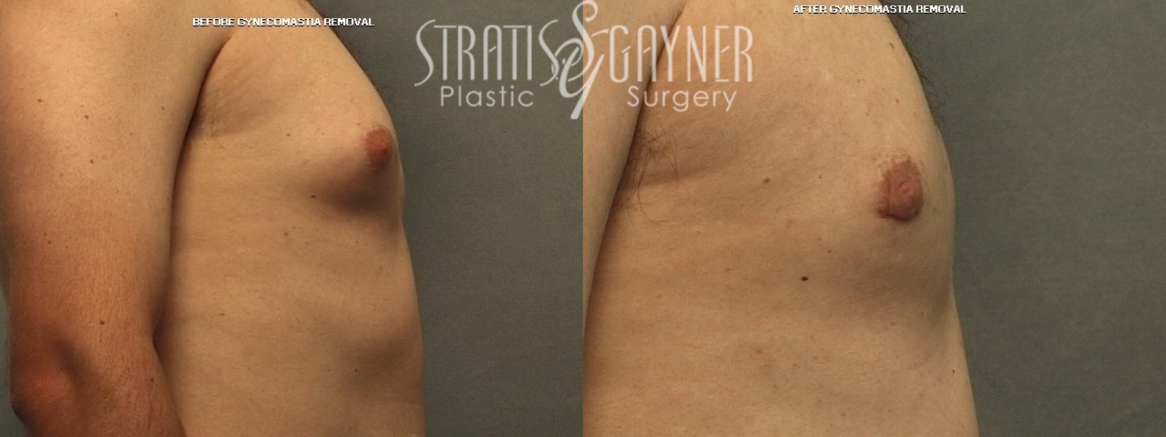 Before & After Male Breast Reduction Case 220 Right Side View in Harrisburg, PA