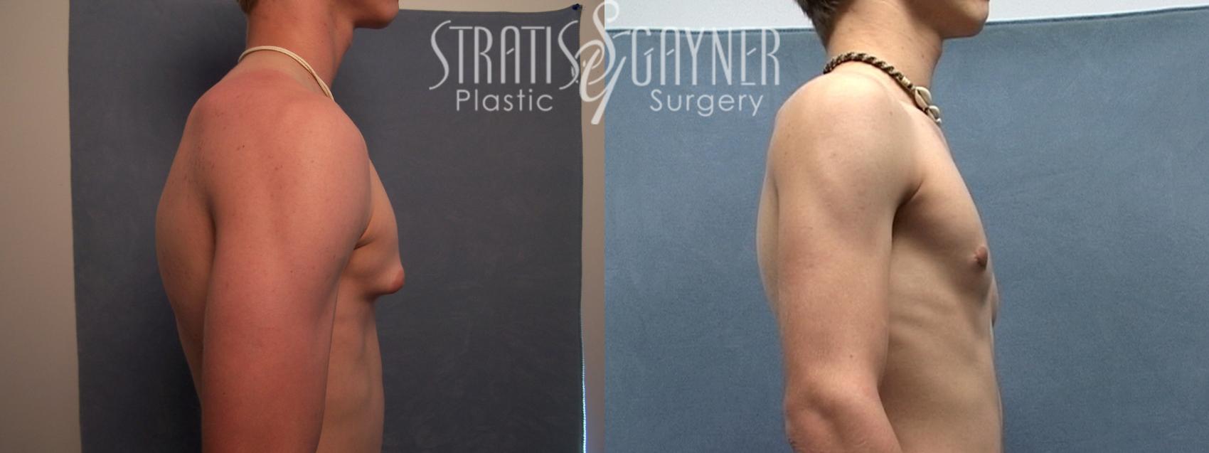 Before & After Male Breast Reduction Case 221 Right Side View in Harrisburg, PA