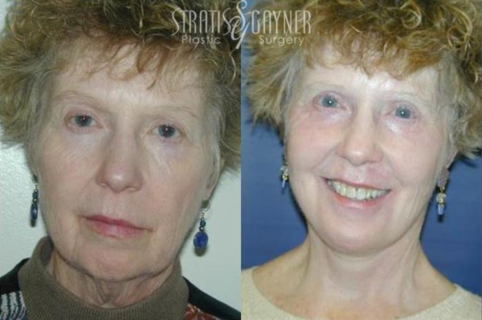 Before & After Quick Recovery Facelift Case 199 View #1 View in Harrisburg, PA