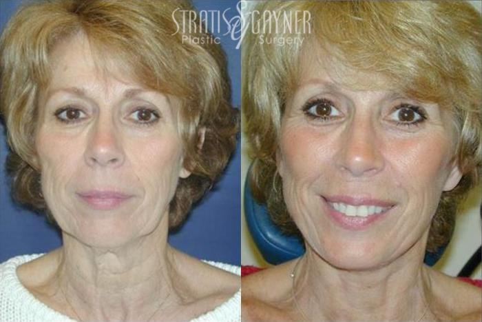 Before & After Quick Recovery Facelift Case 200 View #1 View in Harrisburg, PA