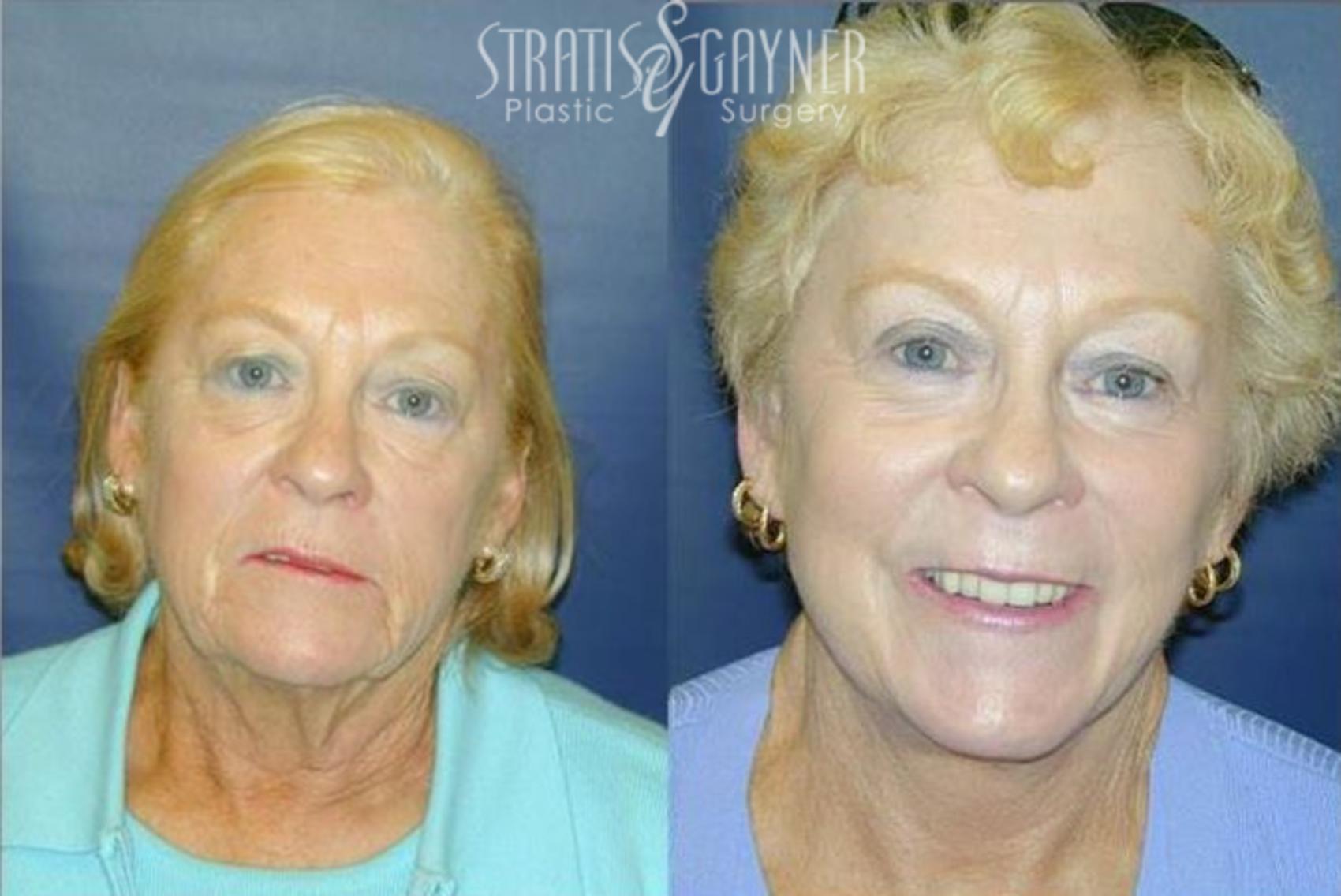 Before & After Quick Recovery Facelift Case 201 View #1 View in Harrisburg, PA