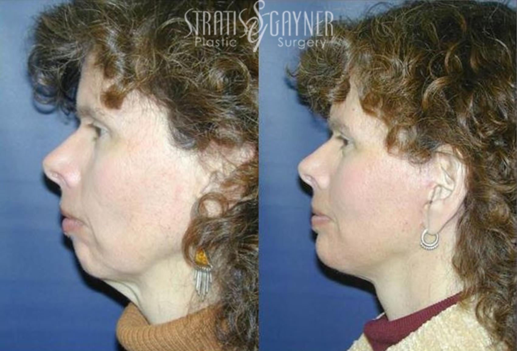 Before & After Quick Recovery Facelift Case 202 View #1 View in Harrisburg, PA