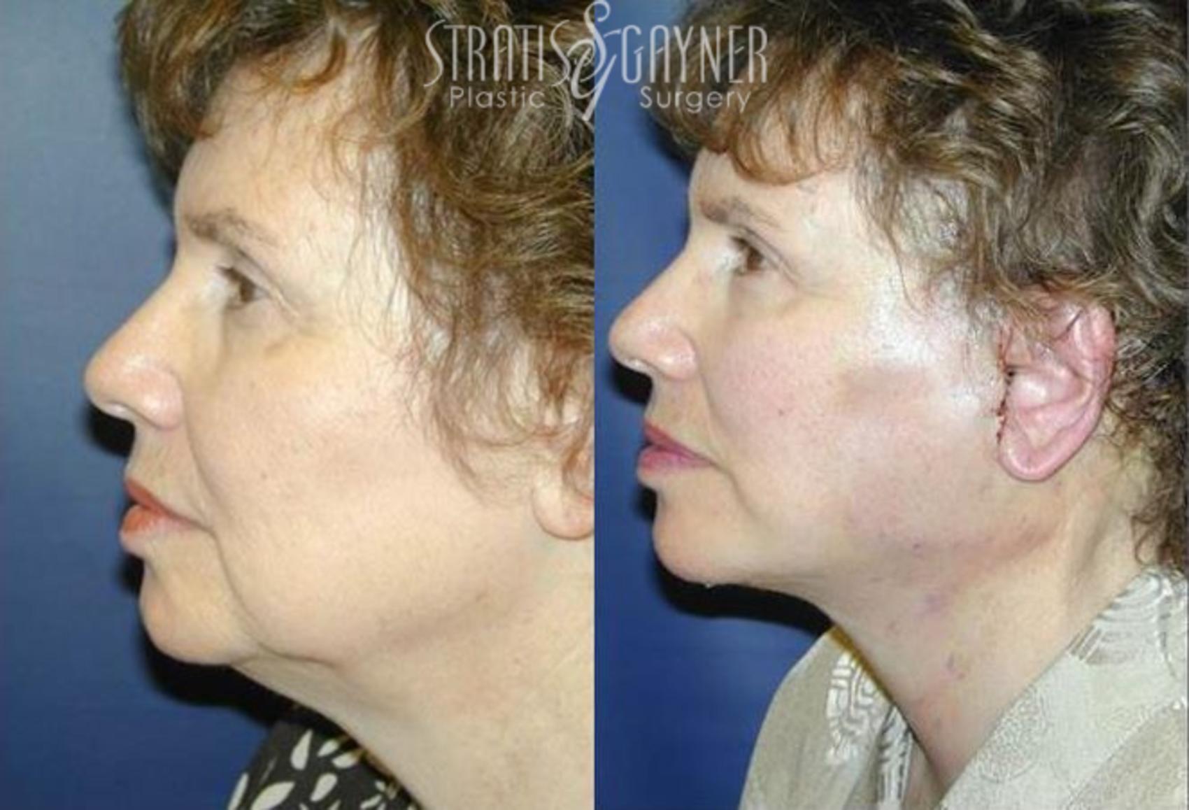 Before & After Quick Recovery Facelift Case 203 View #1 View in Harrisburg, PA
