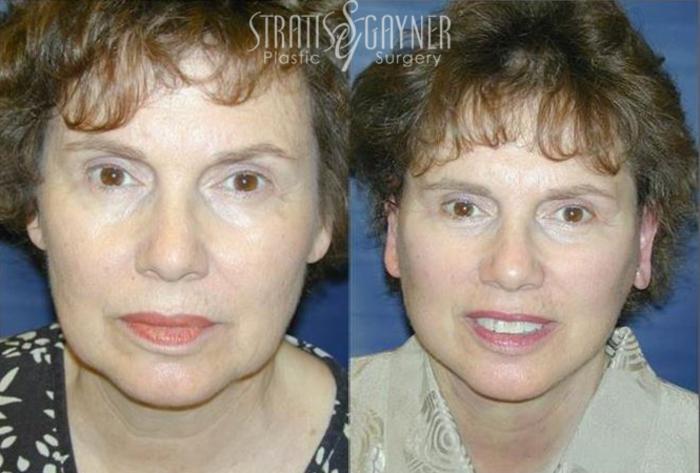 Before & After Quick Recovery Facelift Case 203 View #2 View in Harrisburg, PA