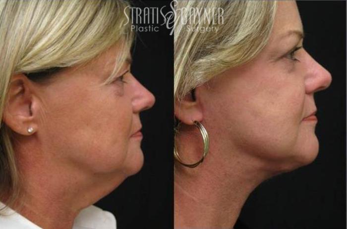 Before & After Quick Recovery Facelift Case 204 View #1 View in Harrisburg, PA