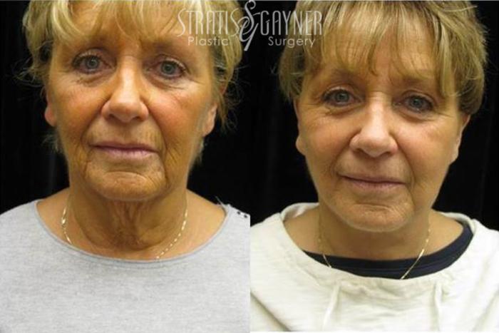 Before & After Quick Recovery Facelift Case 207 View #1 View in Harrisburg, PA