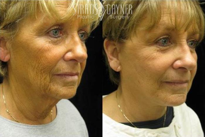 Before & After Quick Recovery Facelift Case 207 View #2 View in Harrisburg, PA