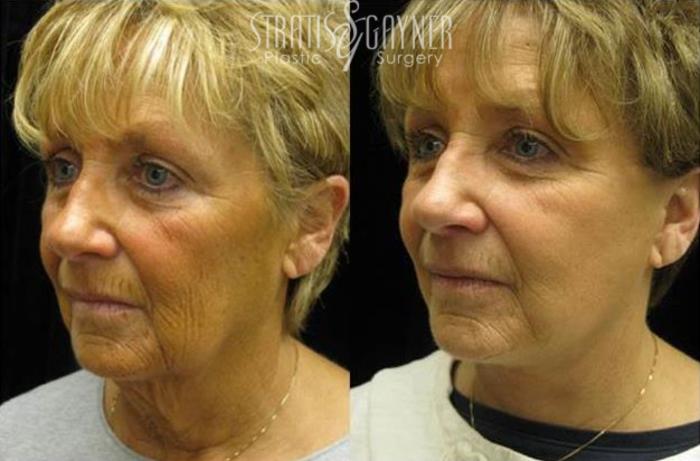 Before & After Quick Recovery Facelift Case 207 View #3 View in Harrisburg, PA