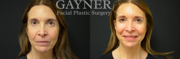 Before & After Quick Recovery Facelift Case 227 Front View in Harrisburg, PA