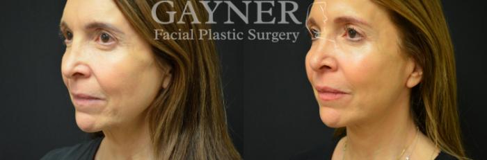 Before & After Quick Recovery Facelift Case 227 Left Oblique View in Harrisburg, PA