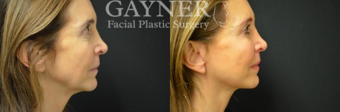 Before & After Quick Recovery Facelift Case 227 Right Side View in Harrisburg, PA
