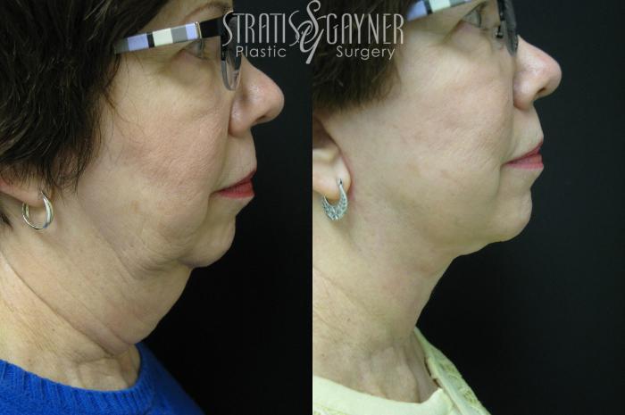 Before & After Quick Recovery Facelift Case 33 View #1 View in Harrisburg, PA