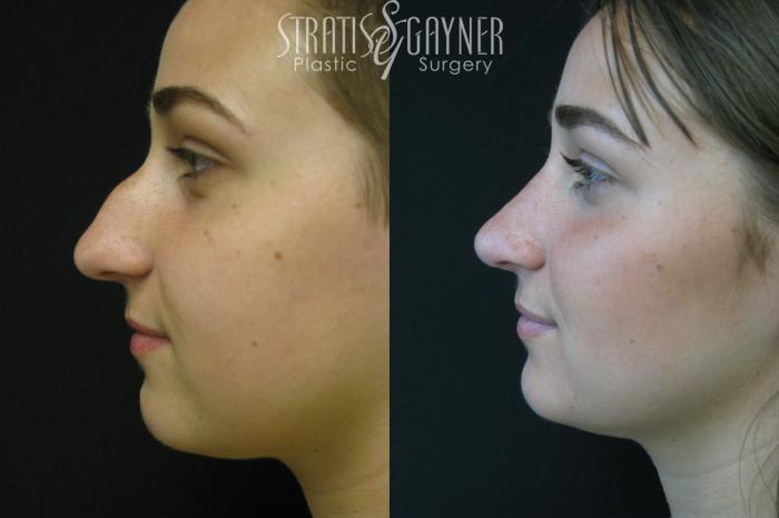 Before & After Rhinoplasty Case 208 View #1 View in Harrisburg, PA