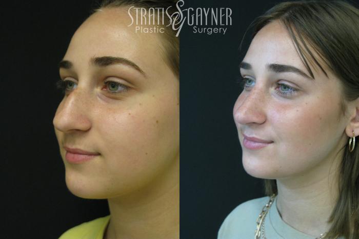 Before & After Rhinoplasty Case 208 View #2 View in Harrisburg, PA